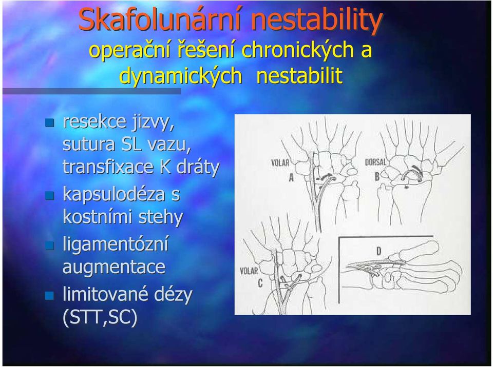 sutura SL vazu, transfixace K dráty kapsulodéza s