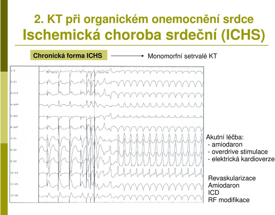 KT Akutní léčba: - amiodaron - overdrive stimulace -