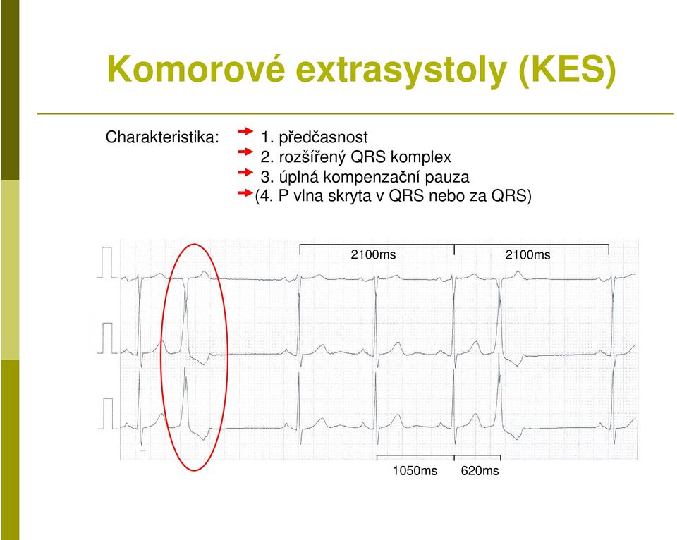 rozšířený QRS komplex 3.