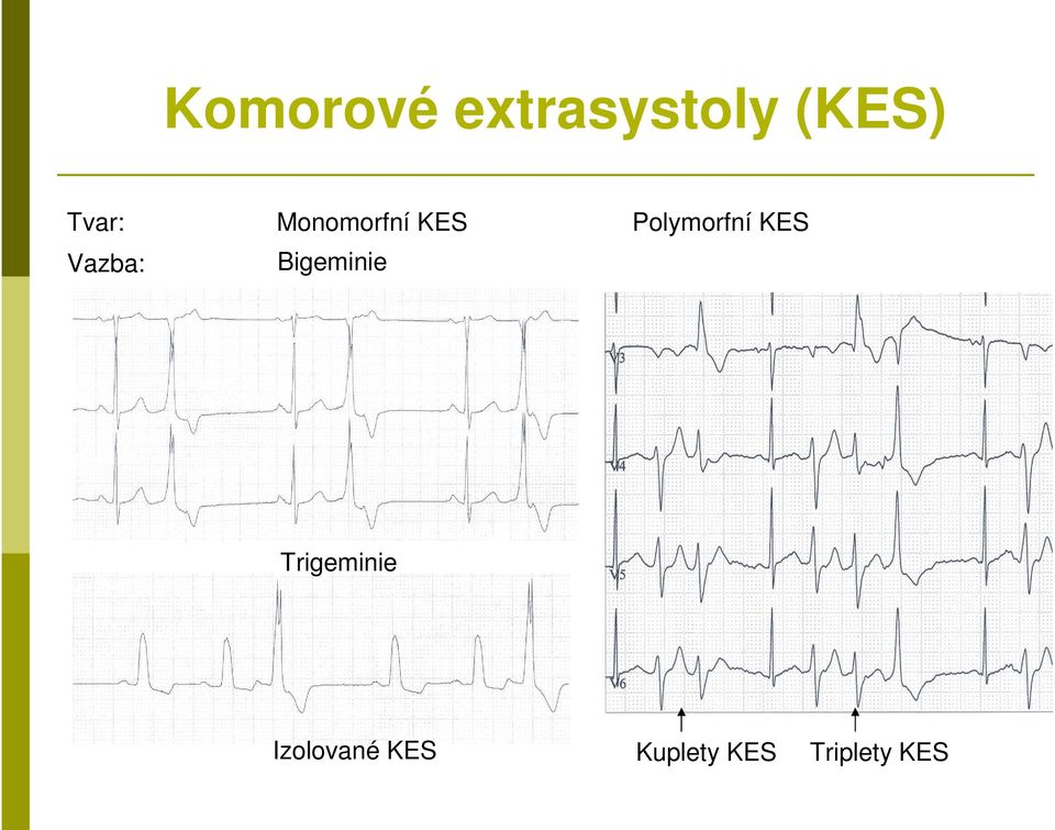 Bigeminie Polymorfní KES