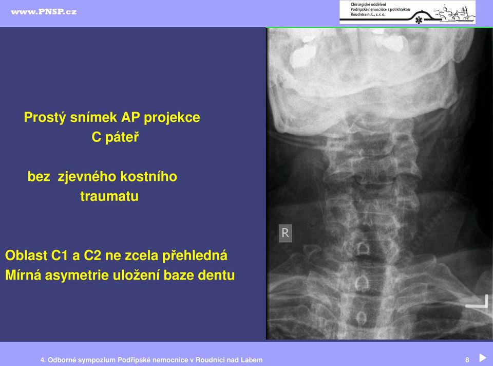 přehledná Mírná asymetrie uložení baze dentu 4.