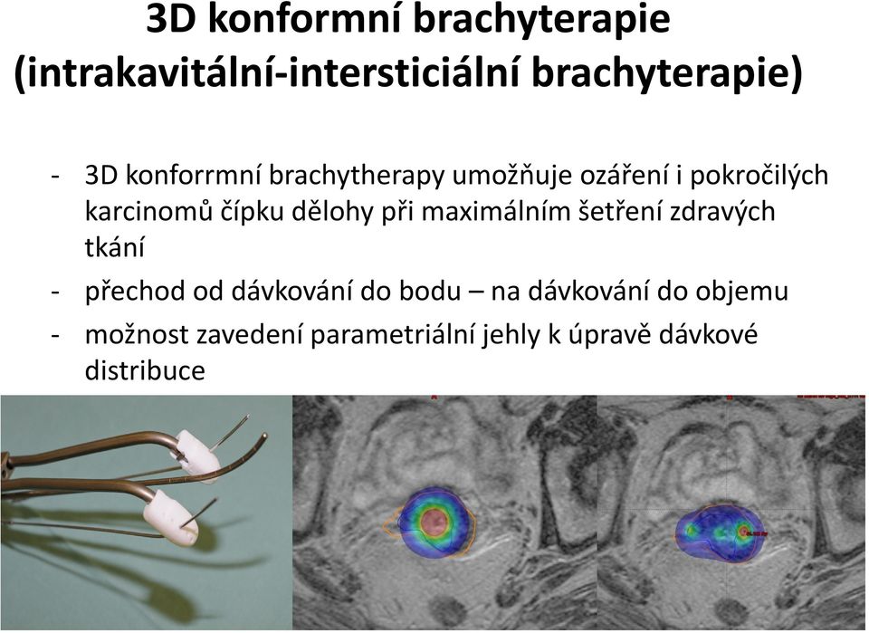 při maximálním šetření zdravých tkání - přechod od dávkování do bodu na