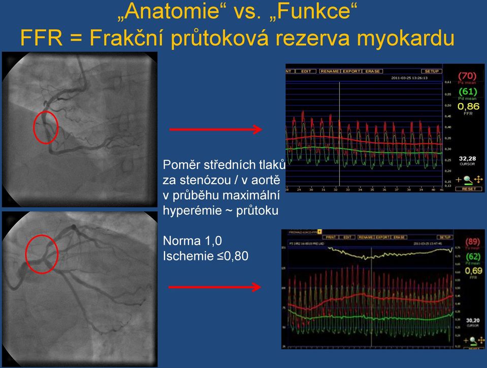 myokardu Poměr středních tlaků za
