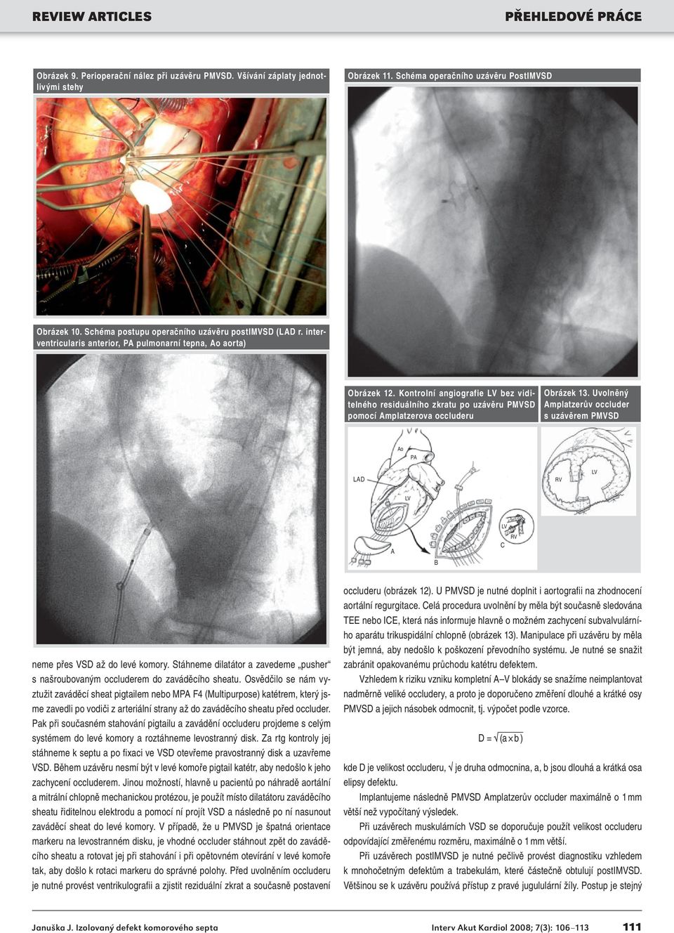 Kontrolní angiografie LV bez viditelného residuálního zkratu po uzávěru PMVSD pomocí Amplatzerova occluderu Obrázek 13.