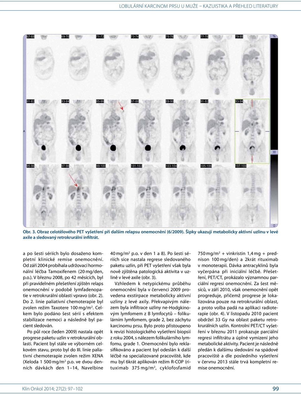 V březnu 2008, po 42 měsících, byl při pravidelném přešetření zjištěn relaps onemocnění v podobě lymfadenopatie v retrokrurální oblasti vpravo (obr. 2). Do 2.