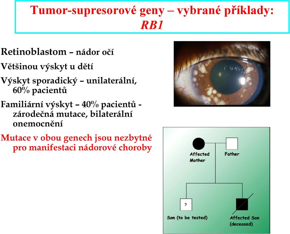 Familiární výskyt 40% pacientů zárodečná mutace, bilaterální
