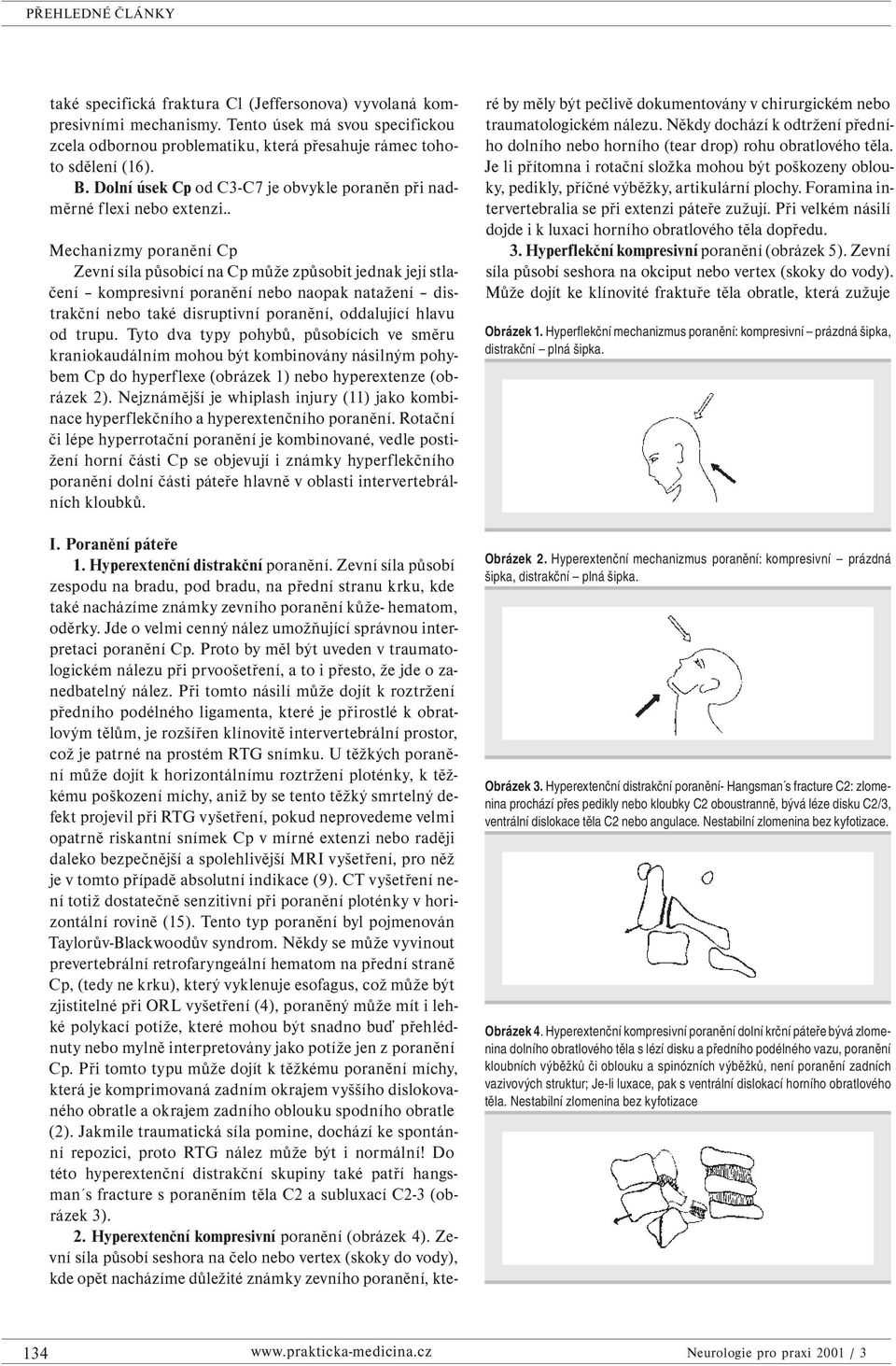 . Mechanizmy poranění Cp Zevní síla působící na Cp může způsobit jednak její stlačení kompresivní poranění nebo naopak natažení distrakční nebo také disruptivní poranění, oddalující hlavu od trupu.