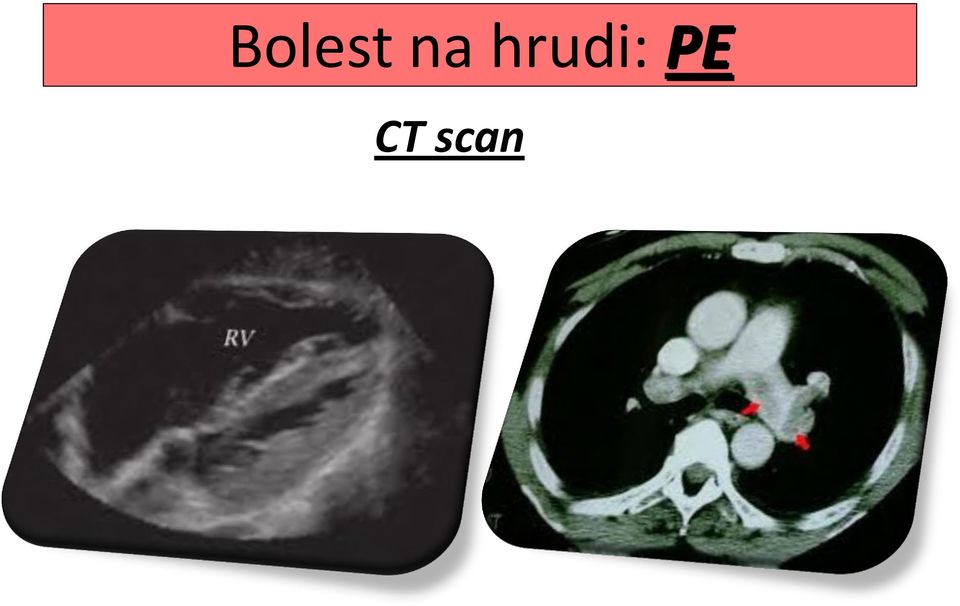 CT scan