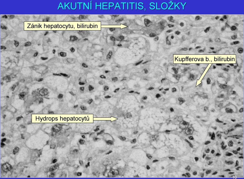 bilirubin Kupfferova b.