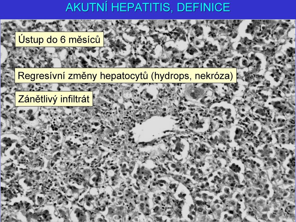 změny hepatocytů (hydrops,