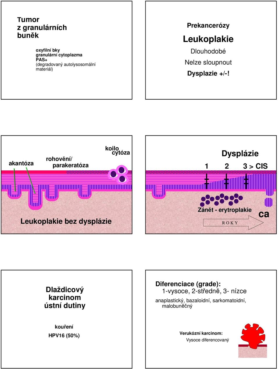 akantóza rohovění/ parakeratóza koilo cytóza Dysplázie 1 2 3 > CIS Leukoplakie bez dysplázie Zánět - erytroplakie R O K Y