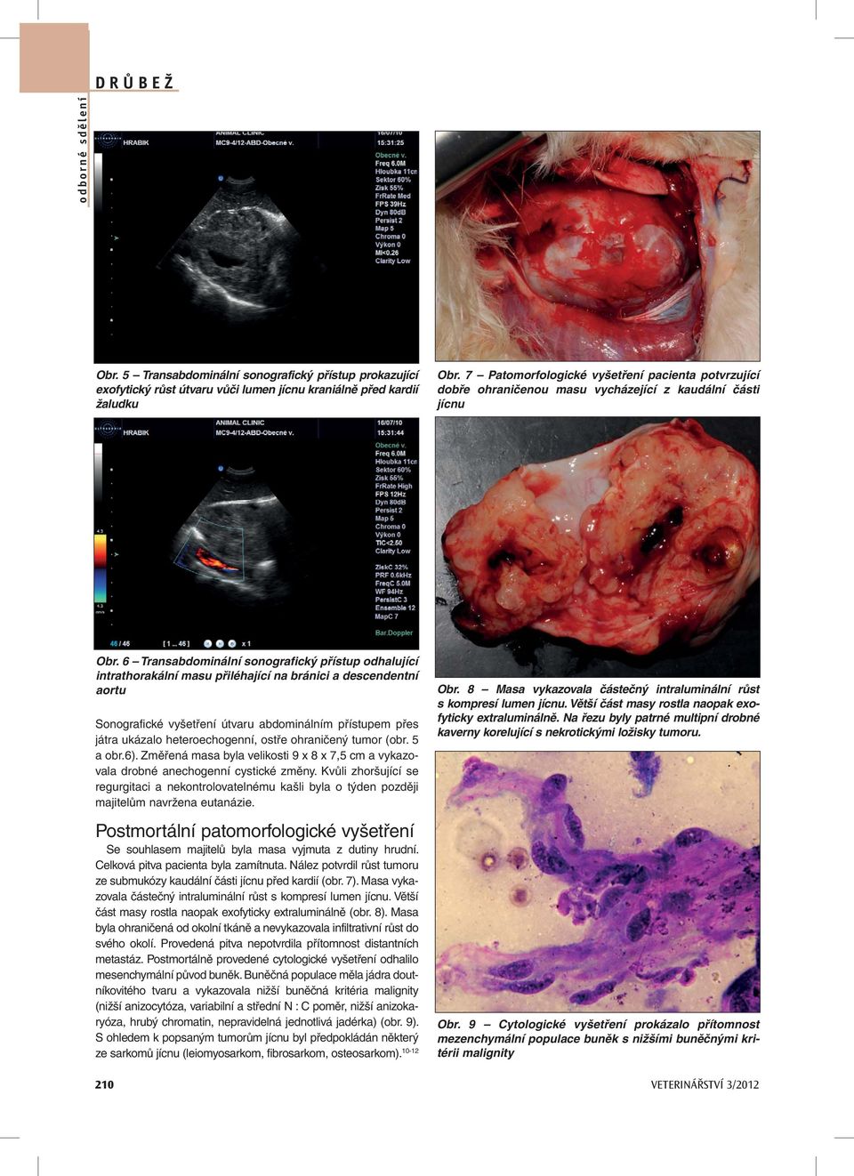 6 Transabdominální sonografický přístup odhalující intrathorakální masu přiléhající na bránici a descendentní aortu Sonografické vyšetření útvaru abdominálním přístupem přes játra ukázalo