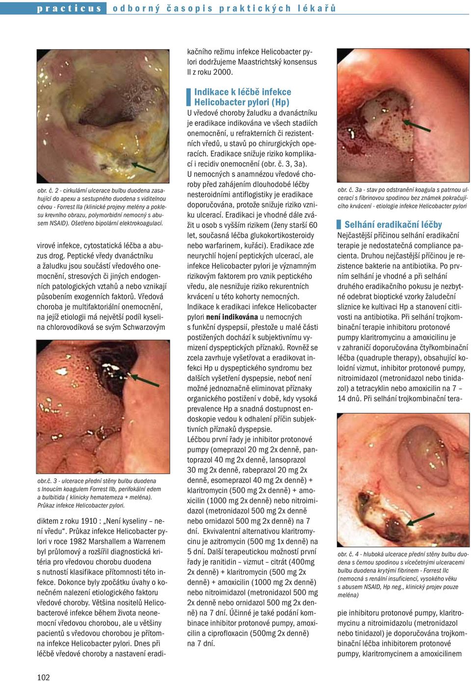 2 - cirkulární ulcerace bulbu duodena zasahující do apexu a sestupného duodena s viditelnou cévou - Forrest IIa (klinické projevy melény a poklesu krevního obrazu, polymorbidní nemocný s abusem