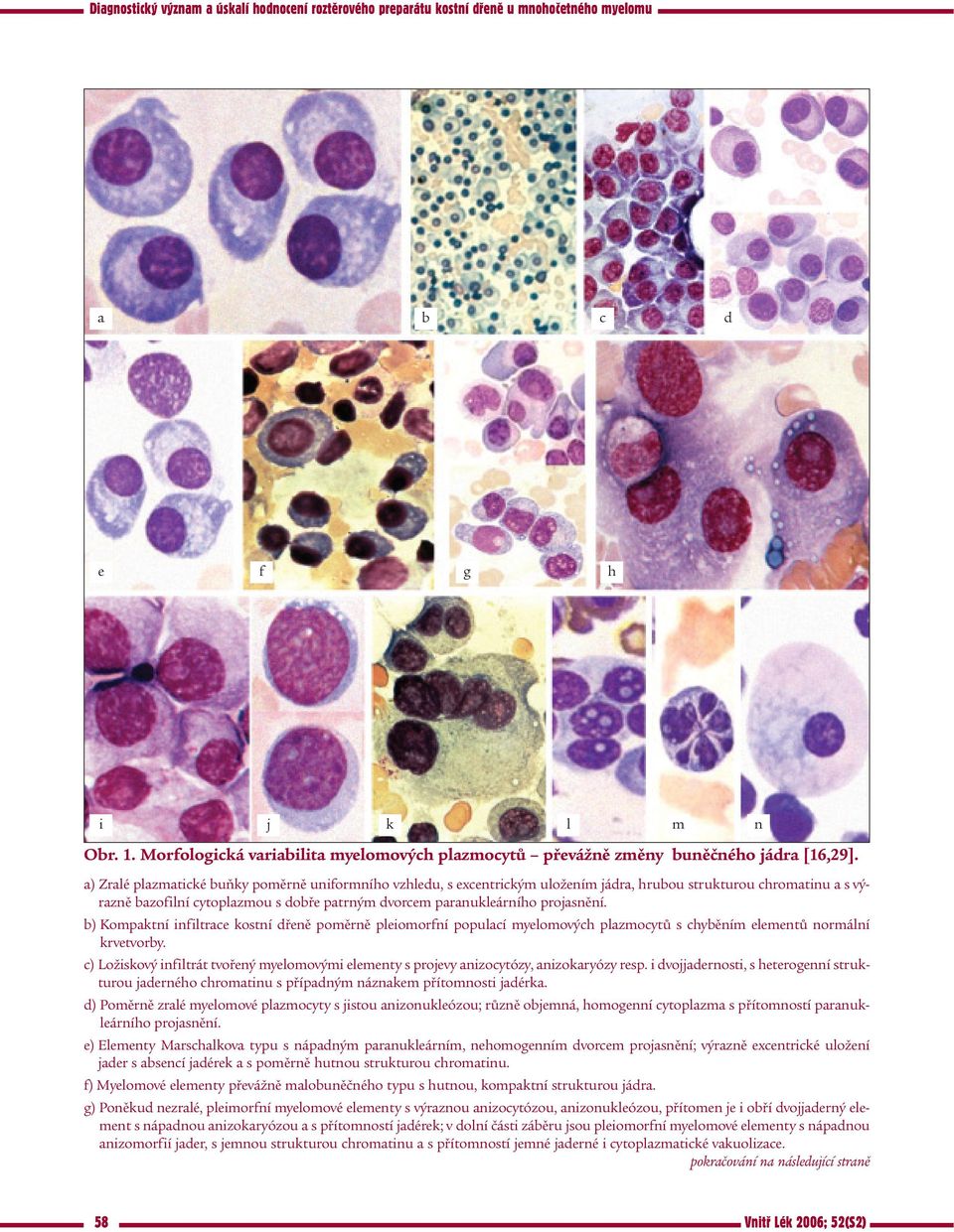 projasnění. b) Kompaktní infiltrace kostní dřeně poměrně pleiomorfní populací myelomových plazmocytů s chyběním elementů normální krvetvorby.