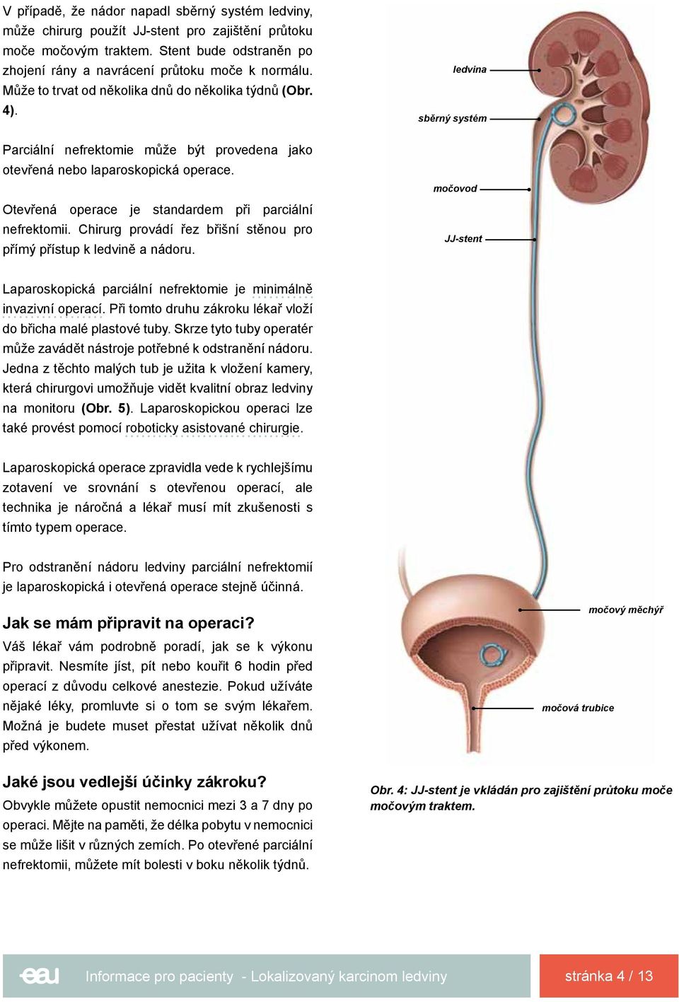 Chirurg provádí řez břišní stěnou pro přímý přístup k ledvině a nádoru. ledvina sběrný systém močovod JJ-stent Laparoskopická parciální nefrektomie je minimálně invazivní operací.