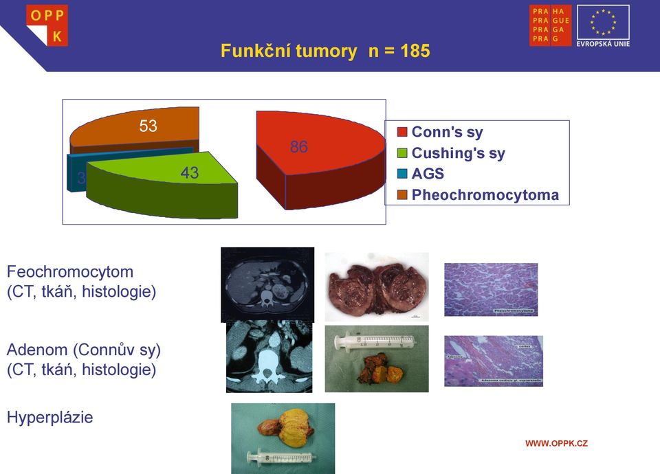 Feochromocytom 48 (CT, tkáň, histologie)