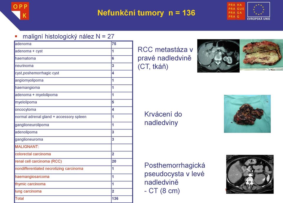 ganglioneuroma 3 MALIGNANT: colorectal carcinoma 2 renal cell carcinoma (RCC) 20 nondifferentiated necrotizing carcinoma 1 haemangiosarcoma 1 thymic