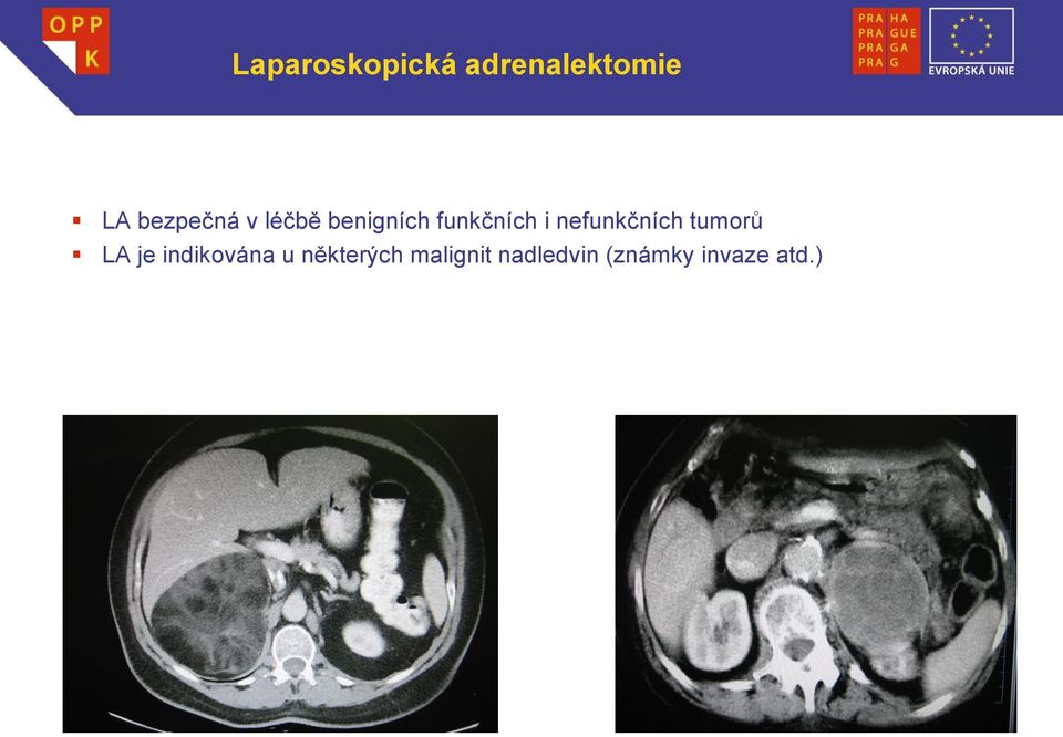 nefunkčních tumorů LA je indikována u