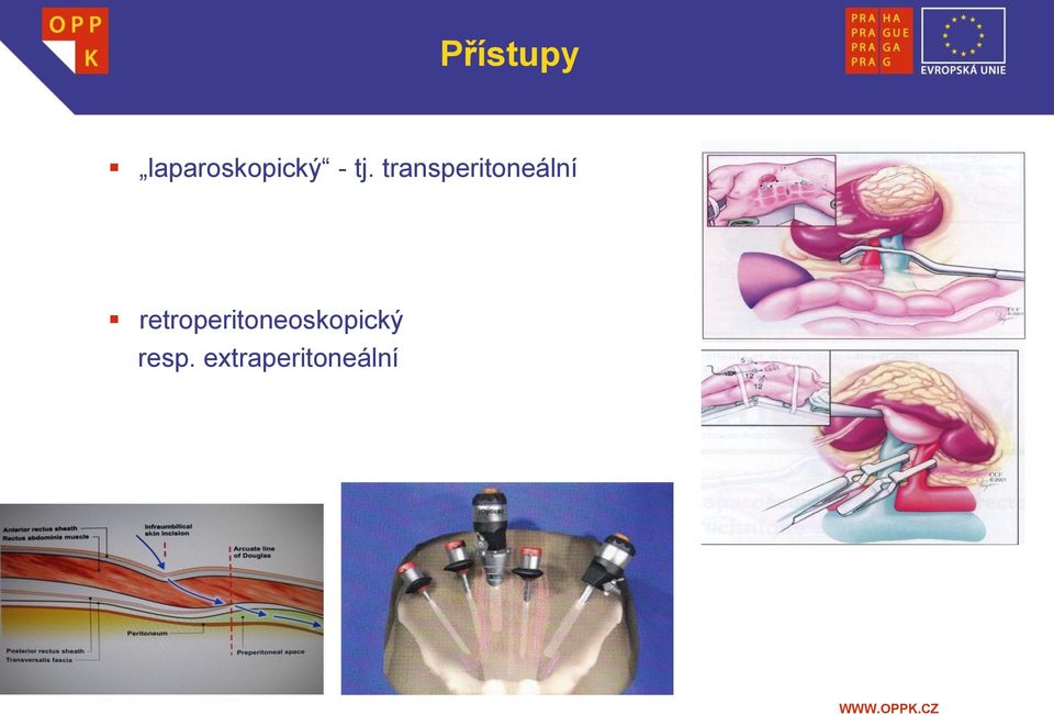 retroperitoneoskopický