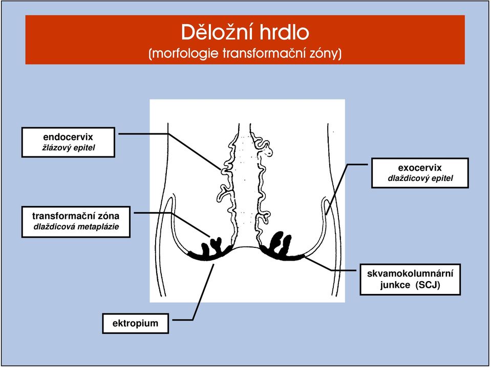 dlaždicový epitel transformační zóna