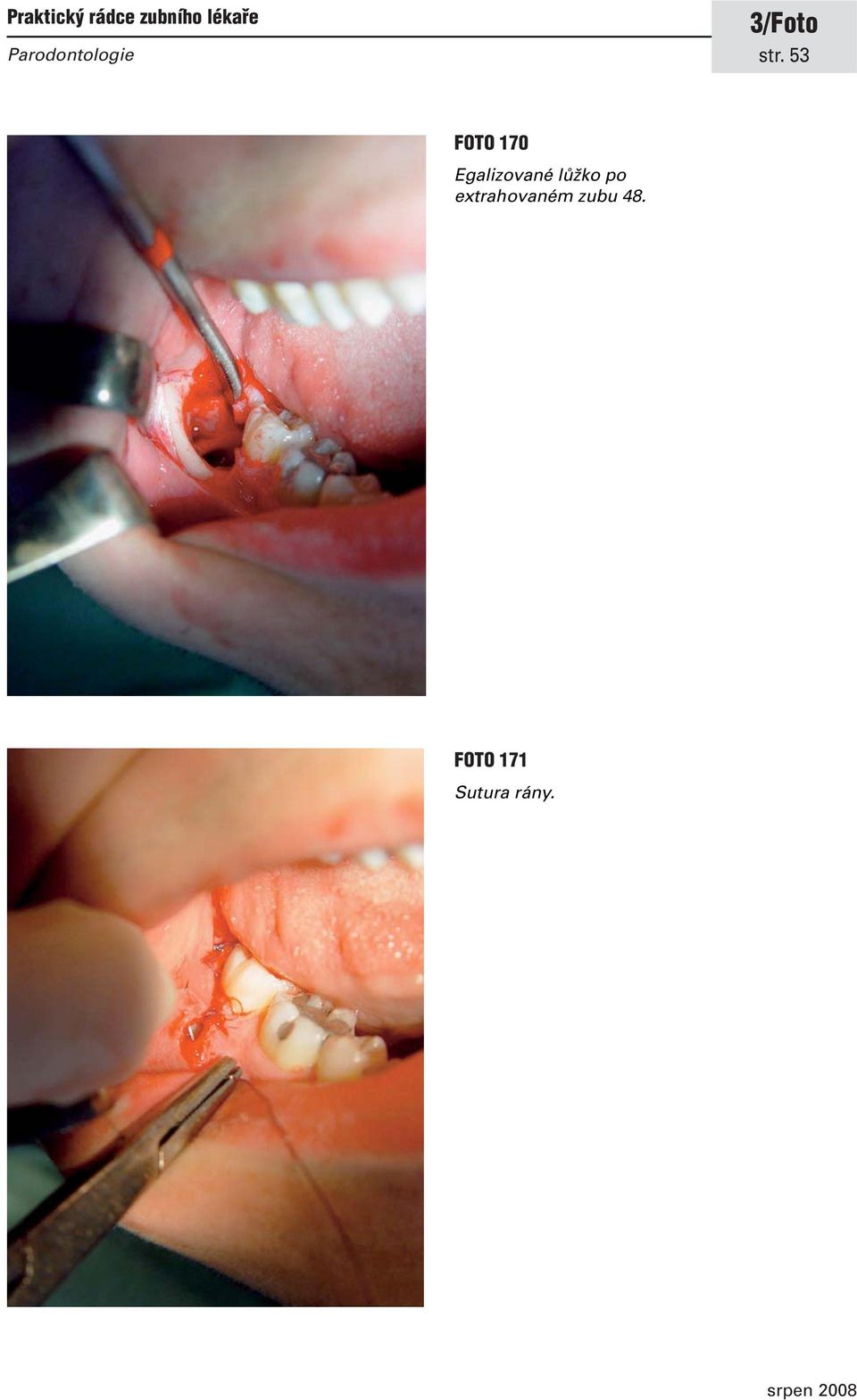 extrahovaném zubu 48.