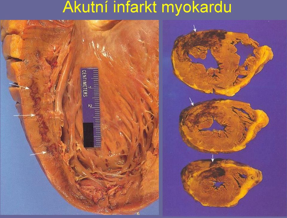 myokardu