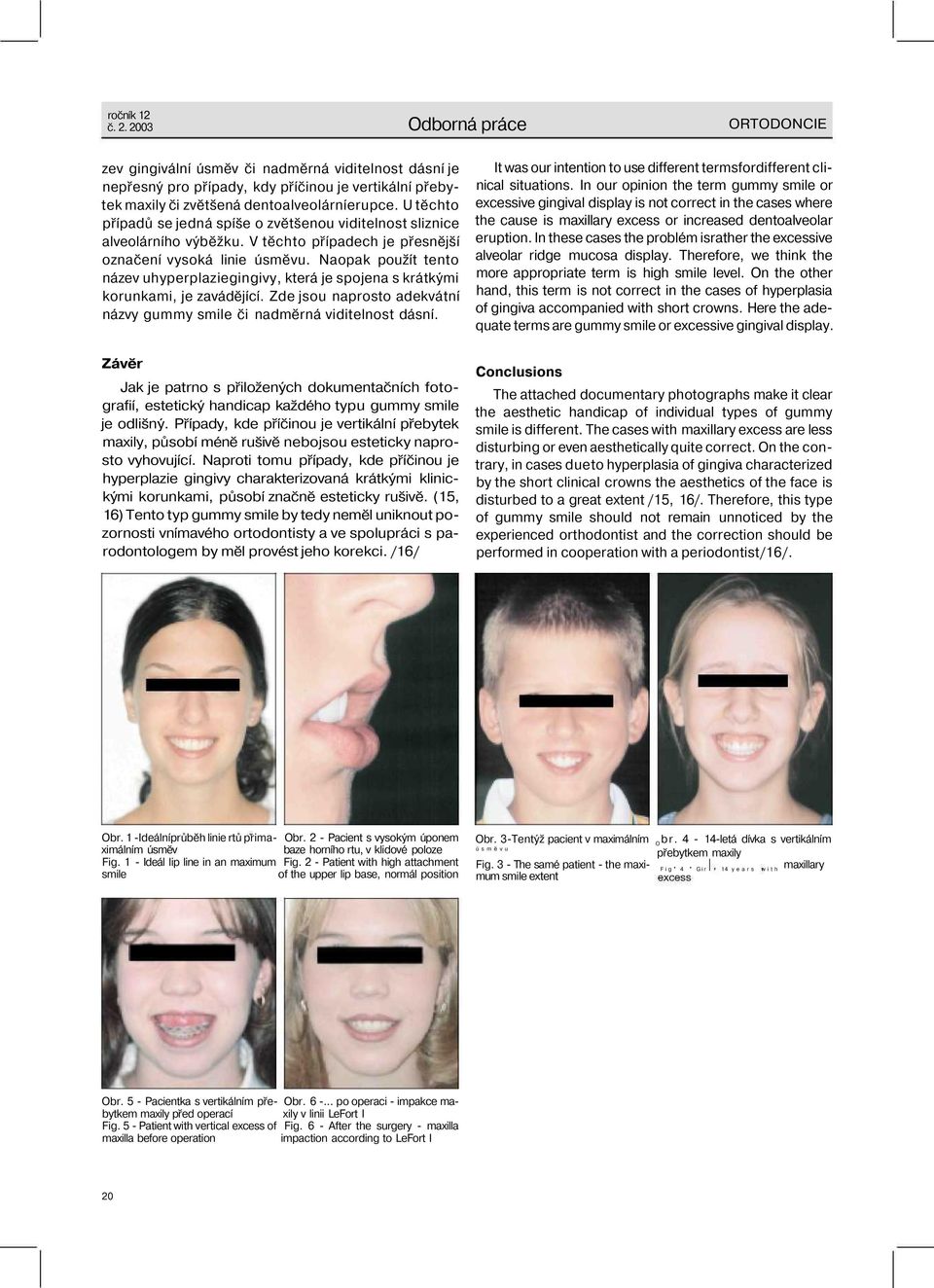 Naopak použít tento název uhyperplaziegingivy, která je spojena s krátkými korunkami, je zavádějící. Zde jsou naprosto adekvátní názvy gummy smile či nadměrná viditelnost dásní.