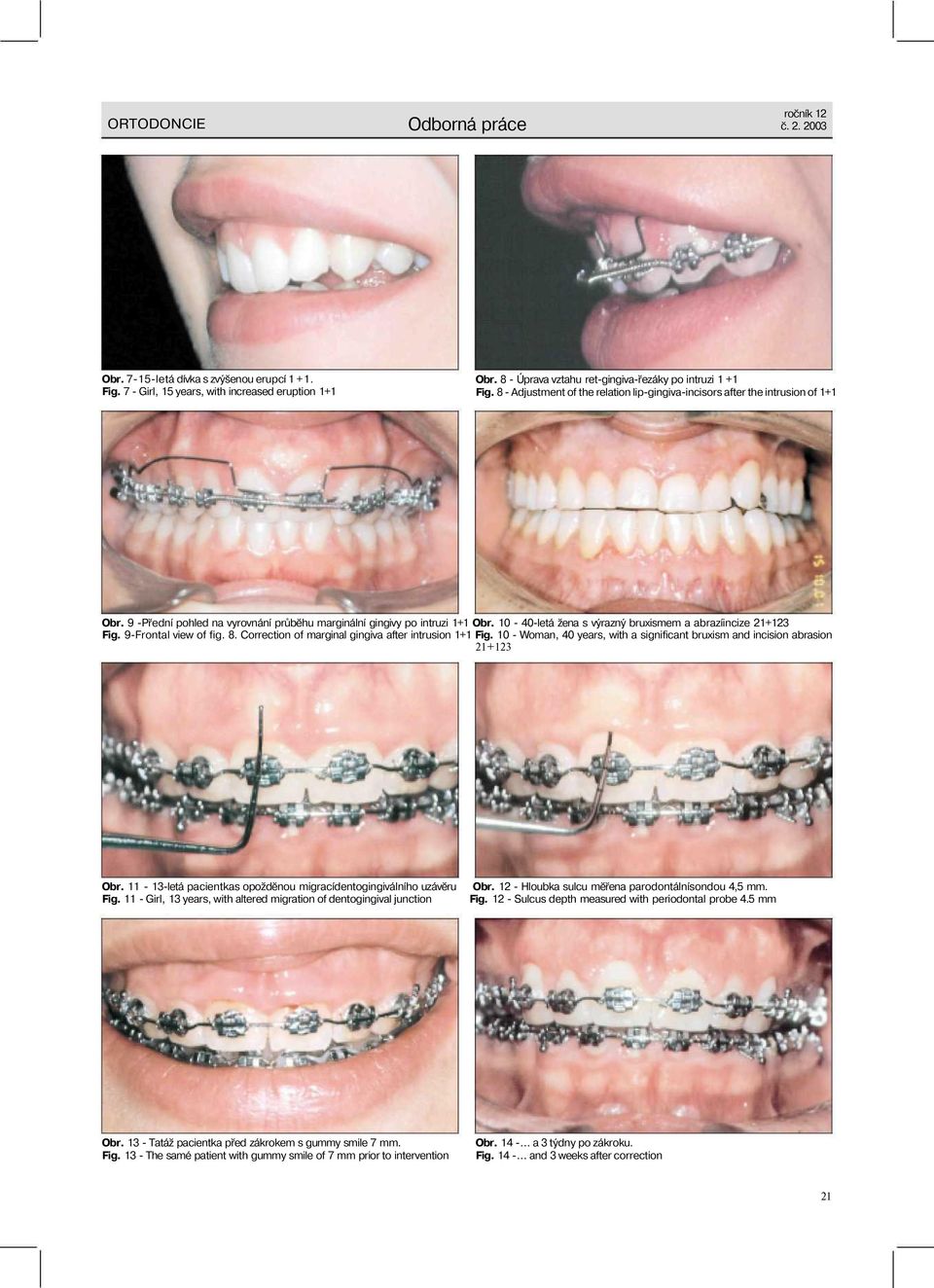 10-40-letá žena s výrazný bruxismem a abrazíincize 21+123 Fig. 9-Frontal view of fig. 8. Correction of marginal gingiva after intrusion 1+1 Fig.