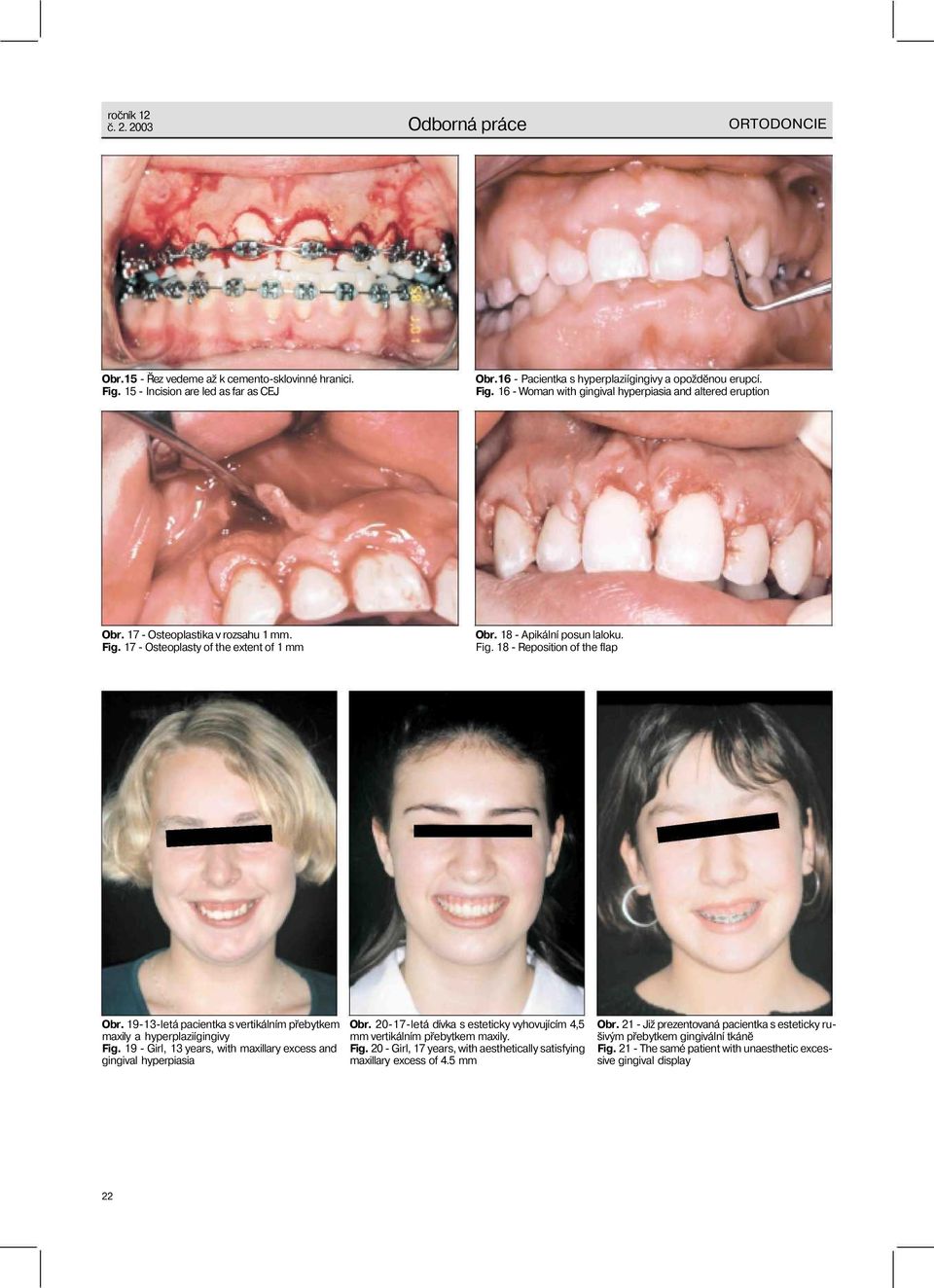 19-13-letá pacientka s vertikálním přebytkem maxily a hyperplaziígingivy Fig. 19 - Girl, 13 years, with maxillary excess and gingival hyperpiasia Obr.