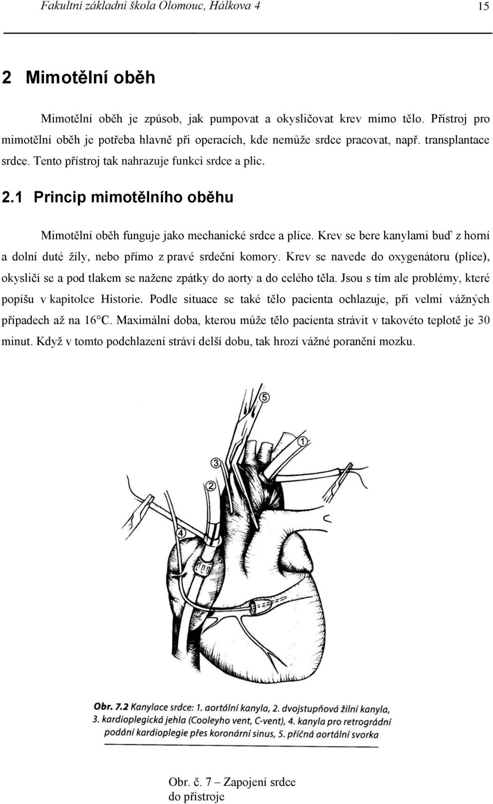 1 Princip mimotělního oběhu Mimotělní oběh funguje jako mechanické srdce a plíce. Krev se bere kanylami buď z horní a dolní duté žíly, nebo přímo z pravé srdeční komory.