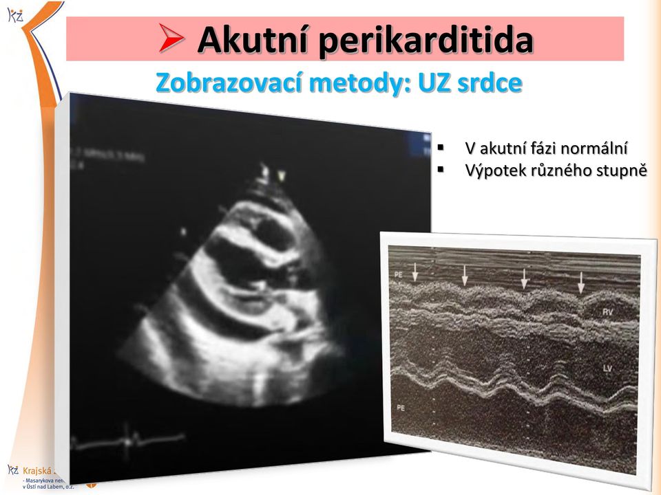 srdce V akutní fázi