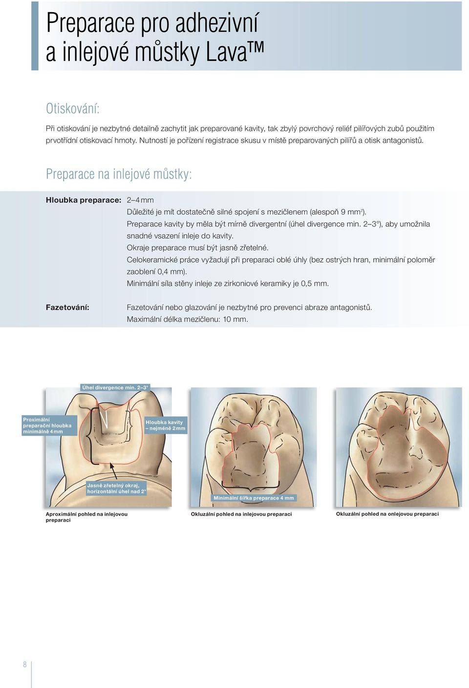 Preparace na inlejové můstky: Hloubka preparace: 2 4 mm Důležité je mít dostatečně silné spojení s mezičlenem (alespoň 9 mm 2 ). Preparace kavity by měla být mírně divergentní (úhel divergence min.