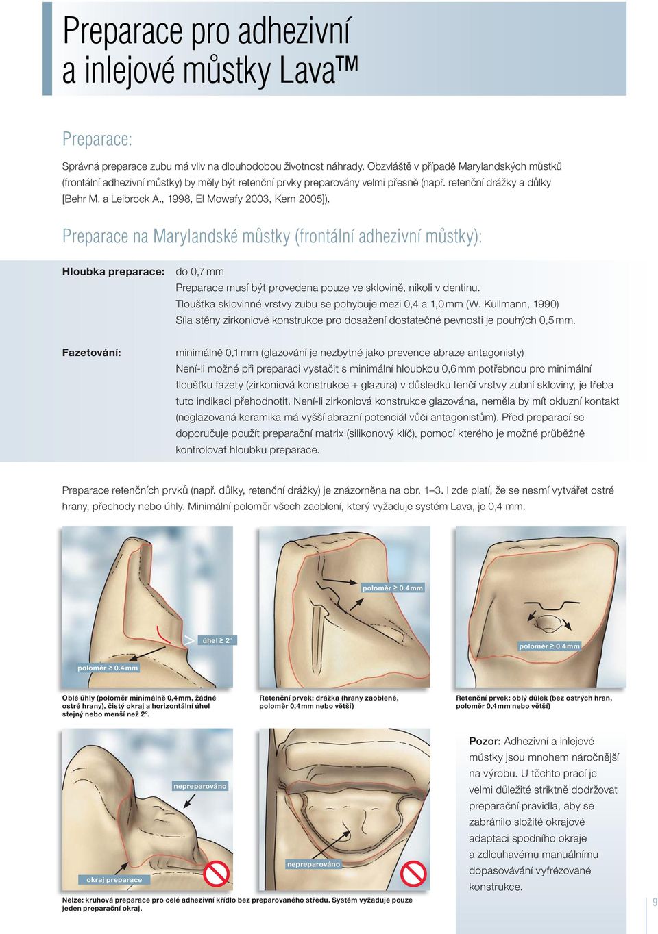 , 1998, El Mowafy 2003, Kern 2005]). Preparace na Marylandské můstky (frontální adhezivní můstky): Hloubka preparace: do 0,7 mm Preparace musí být provedena pouze ve sklovině, nikoli v dentinu.