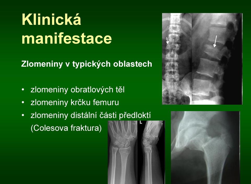 obratlových těl zlomeniny krčku femuru