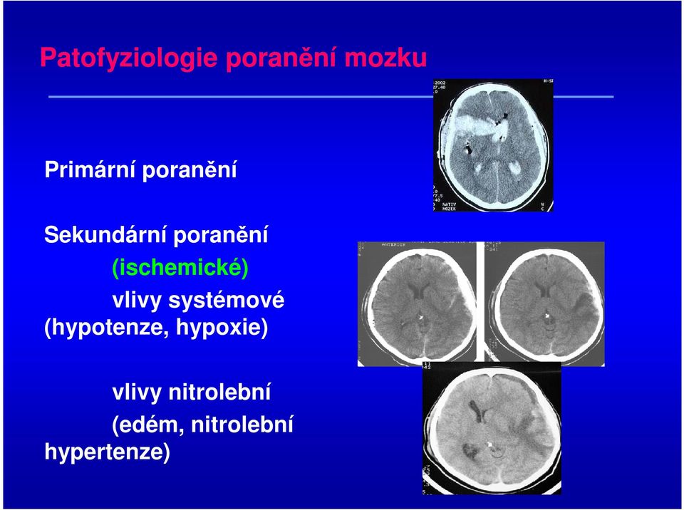 (ischemické) vlivy systémové (hypotenze,