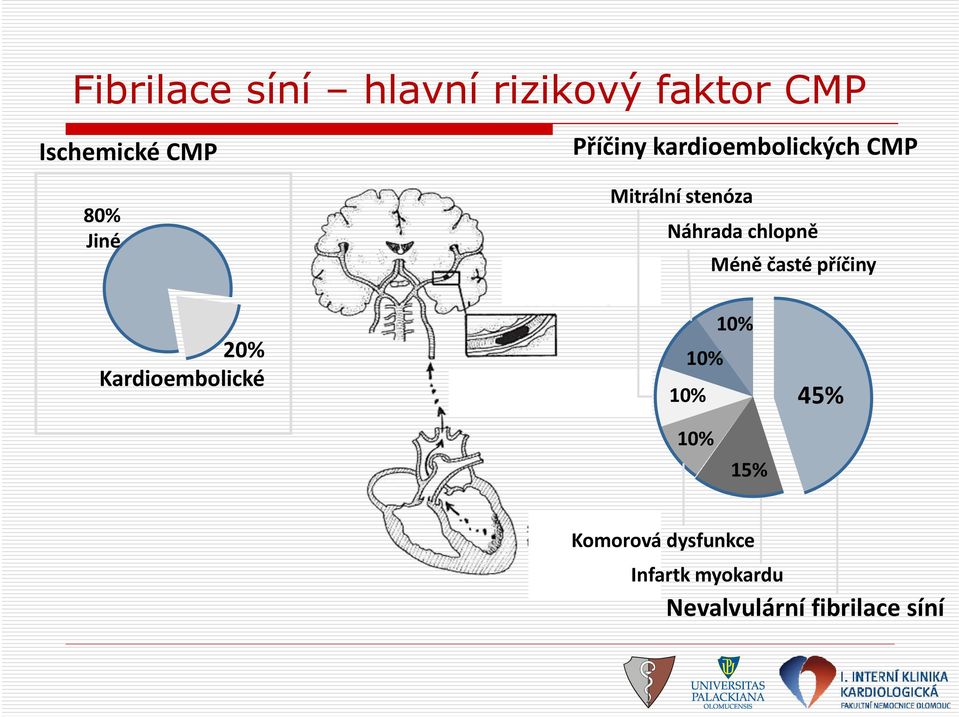 chlopně Méně časté příčiny 20% Kardioembolické 10% 10% 10% 45%