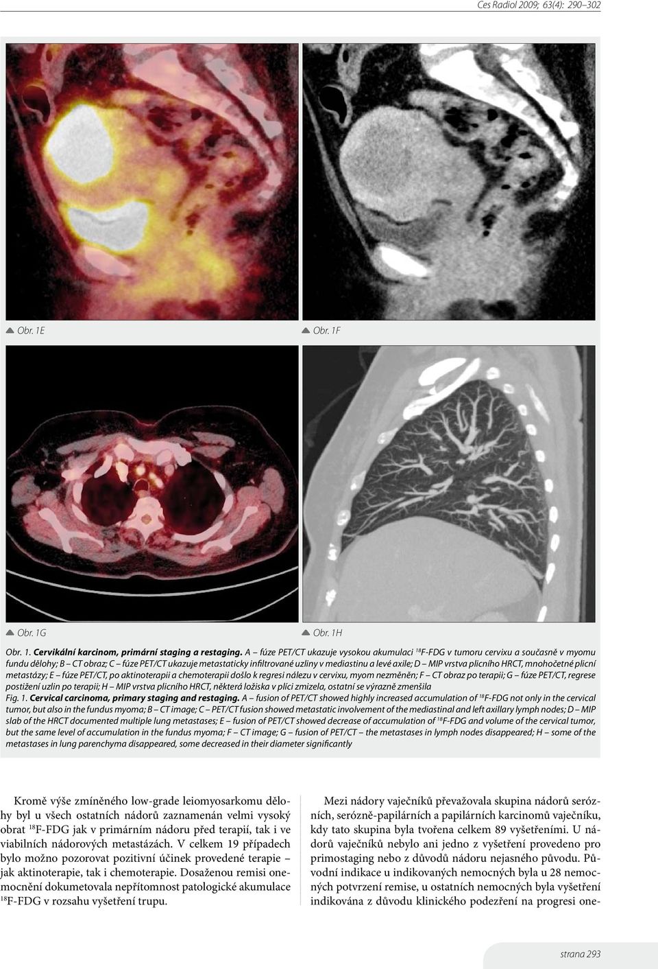 vrstva plicního HRCT, mnohočetné plicní metastázy; E fúze PET/CT, po aktinoterapii a chemoterapii došlo k regresi nálezu v cervixu, myom nezměněn; F CT obraz po terapii; G fúze PET/CT, regrese