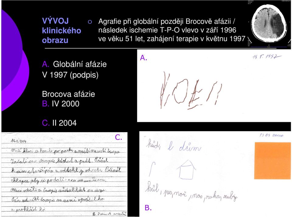 ve věku 51 let, zahájení terapie v květnu 1997 A.