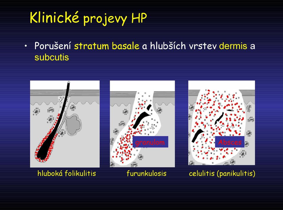 subcutis granulom Absces absces hluboká