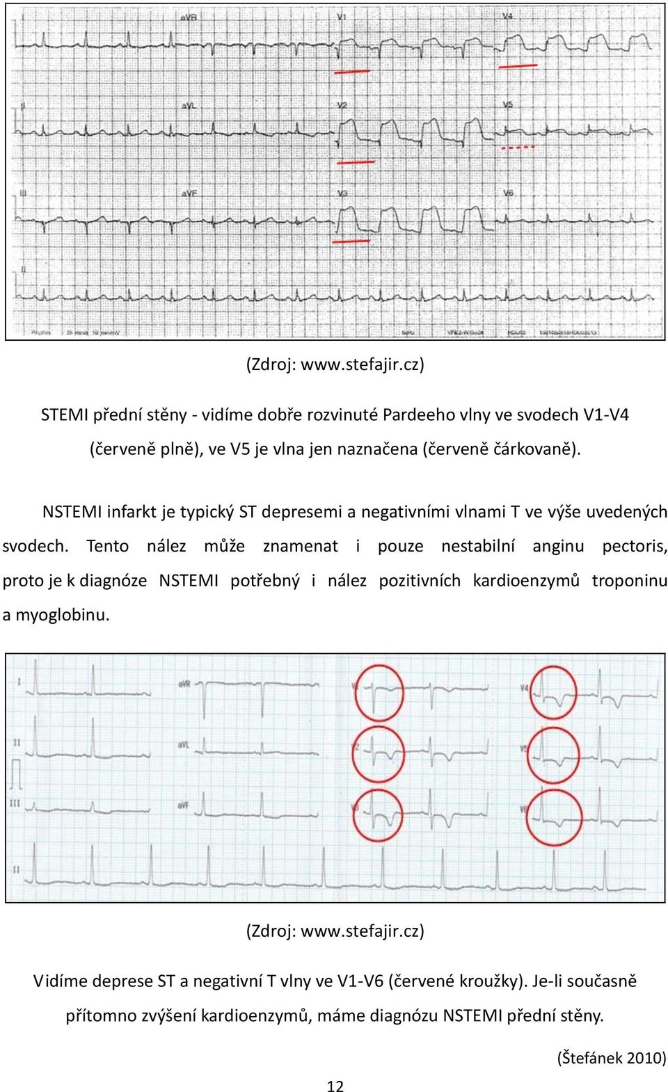 NSTEMI infarkt je typický ST depresemi a negativními vlnami T ve výše uvedených svodech.