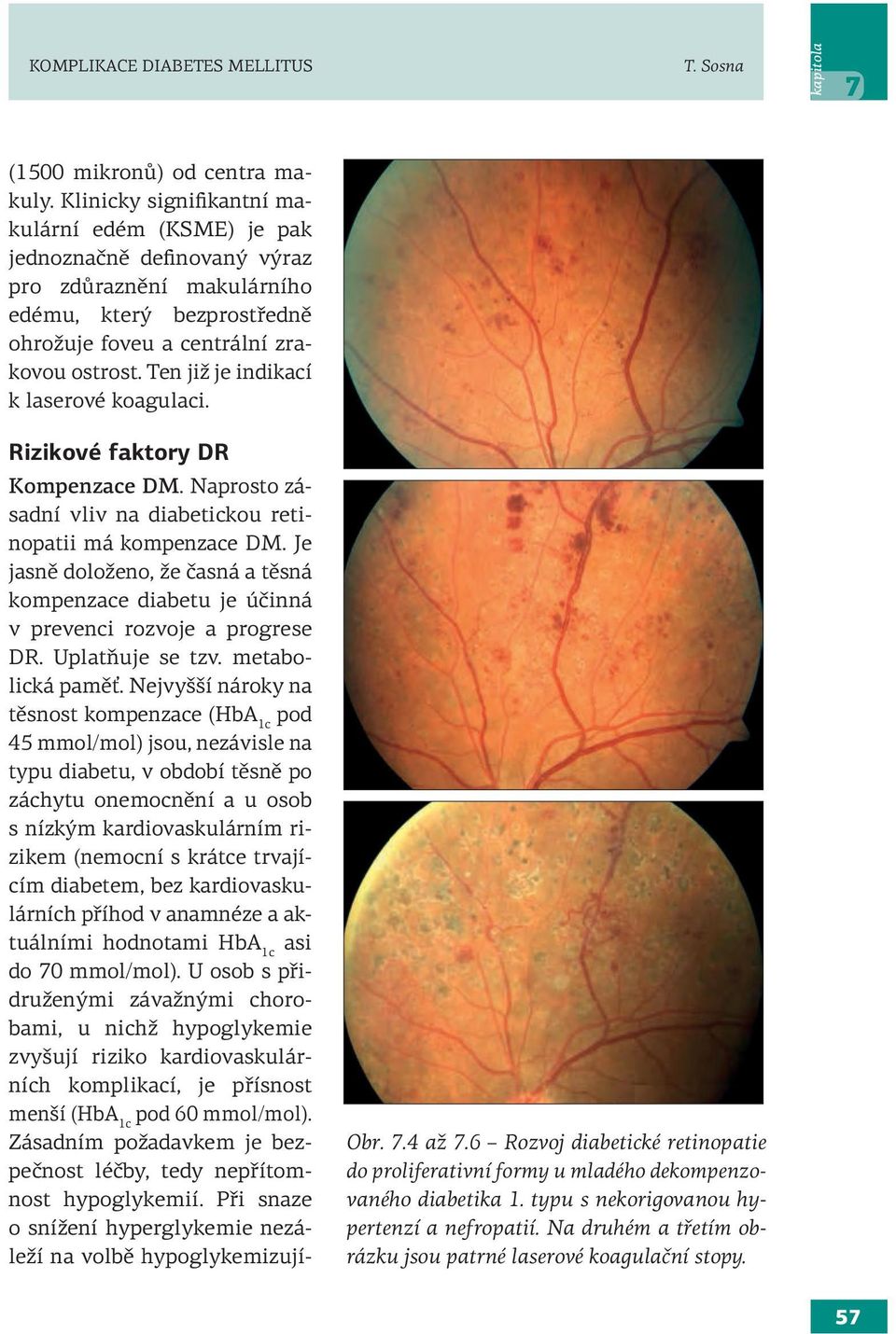 Ten již je indikací k laserové koagulaci. Rizikové faktory DR Kompenzace DM. Naprosto zásadní vliv na diabetickou retinopatii má kompenzace DM.