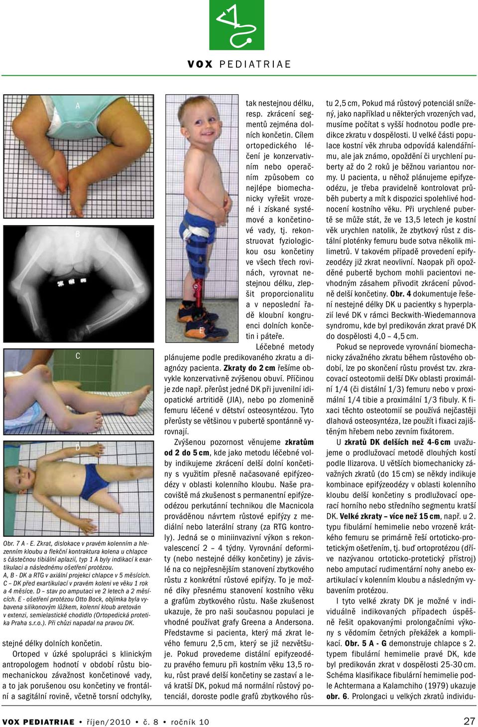 A, B - DK a RTG v axiální projekci chlapce v 5 měsících. C DK před exartikulací v pravém koleni ve věku 1 rok a 4 měsíce. D stav po amputaci ve 2 letech a 2 měsících.