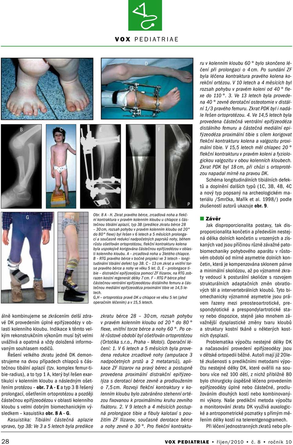 Řešení velkého zkratu jedné DK demonstrujeme na dvou případech chlapců s částečnou tibální aplazií (tzv.