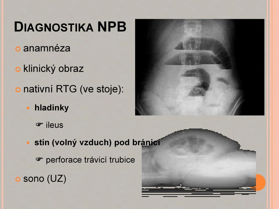 hladinky ileus stín (volný vzduch)