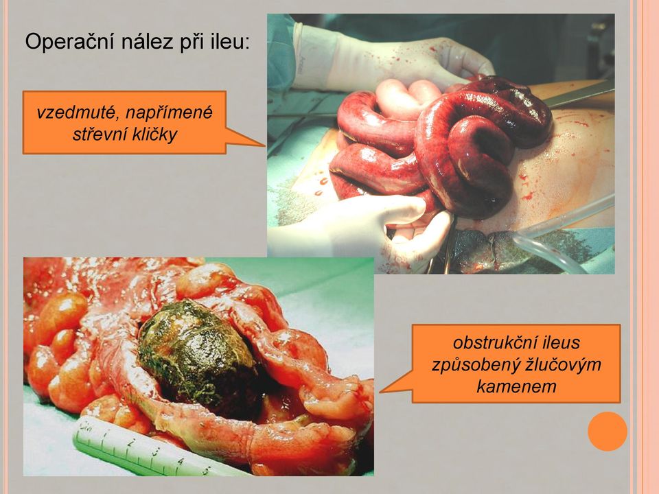 střevní kličky obstrukční