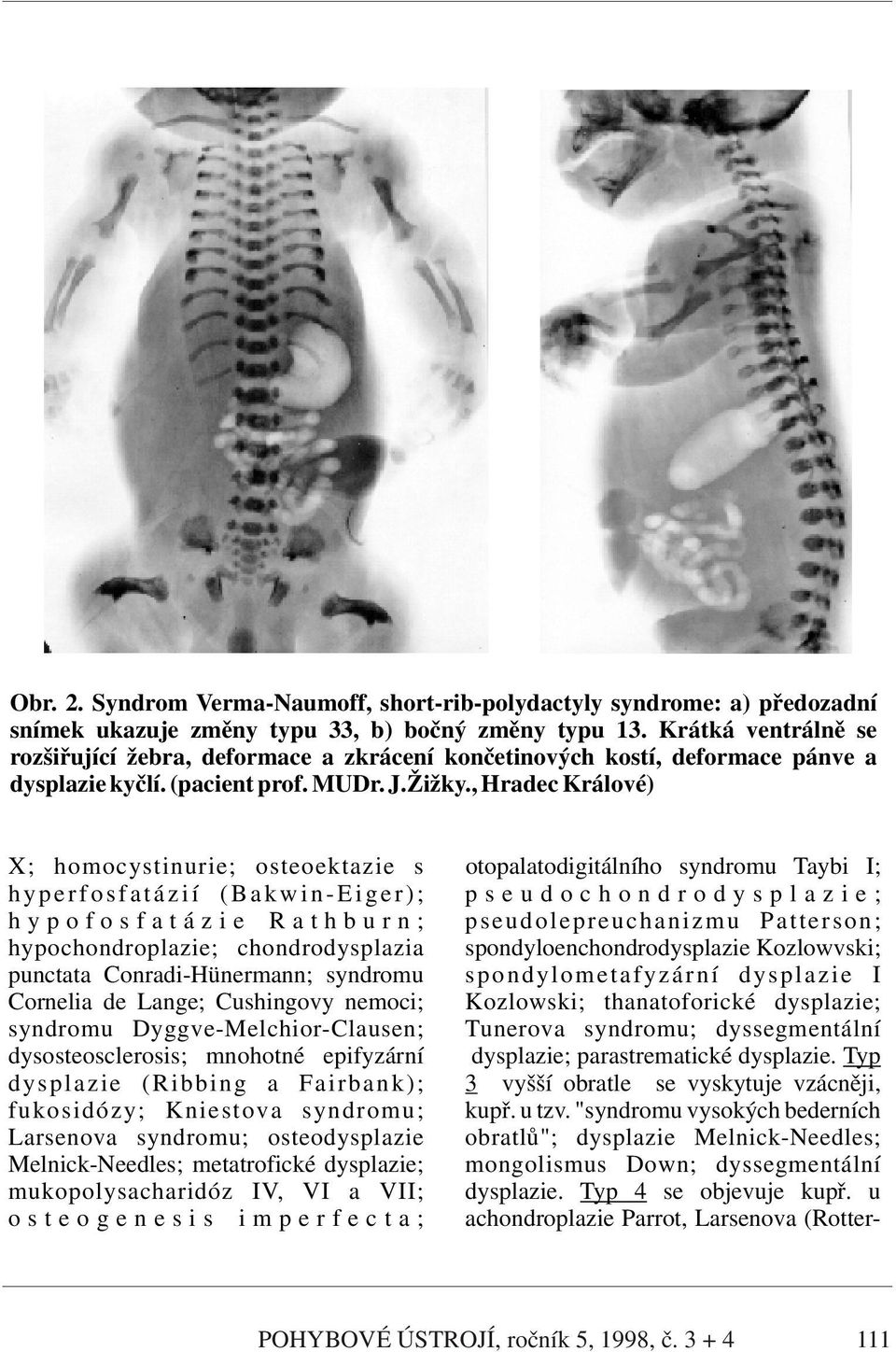 , Hradec Králové) X; homocystinurie; osteoektazie s otopalatodigitálního syndromu Taybi I; h y p e r f o s f a t á z i í ( B a k w i n - E i g e r ) ; p s e u d o c h o n d r o d y s p l a z i e ; h