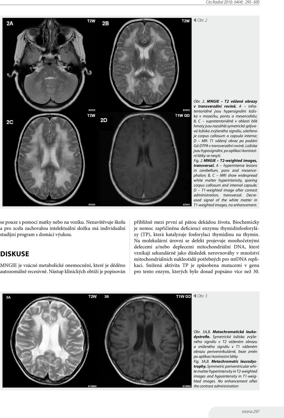 corpus callosum a capsula interna; D MR: T1 vážený obraz po podání Gd-DTPA v transverzální rovině. Ložiska jsou hyposignální, po aplikaci kontrastní látky se nesytí. Fig.