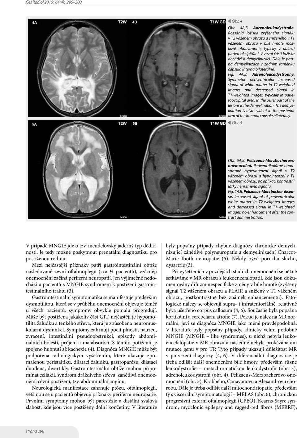 Symmetric periventricular increased signal of white matter in T2-weighted images and decreased signal in T1-weighted images, typically in parietooccipital area.