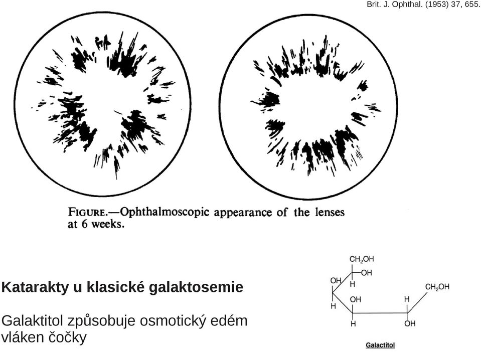 Katarakty u klasické