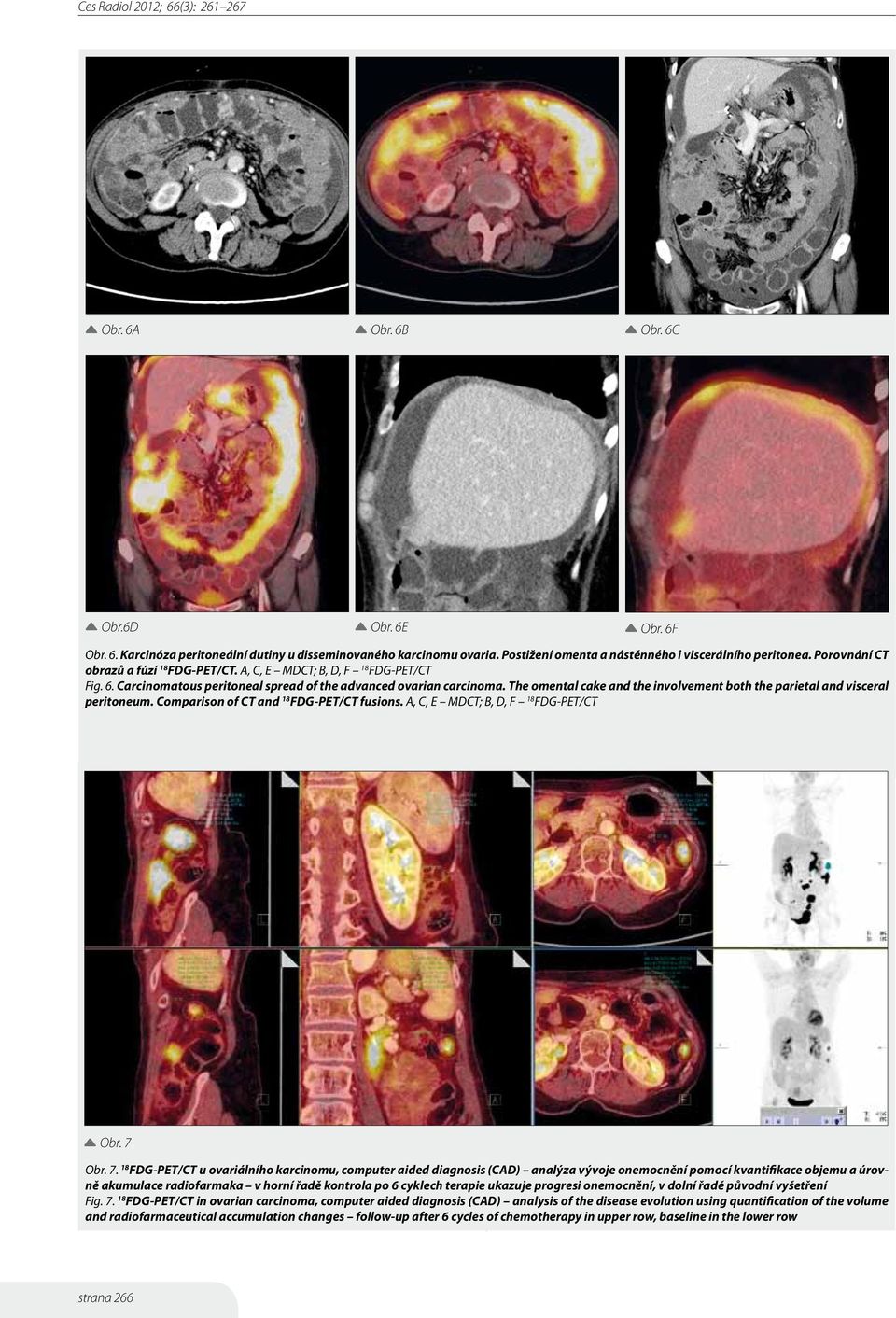 The omental cake and the involvement both the parietal and visceral peritoneum. Comparison of CT and 18 FDG-PET/CT fusions. A, C, E MDCT; B, D, F 18 FDG-PET/CT Obr. 7 